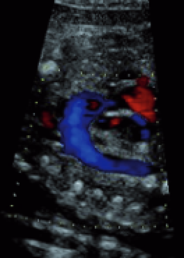 Fetalni ultrazvok srca ZCD