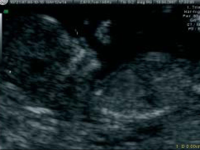 12. teden nosečnosti, preiskava nuhalna svetlina, pri nas tudi na napotnico, nosna kost
