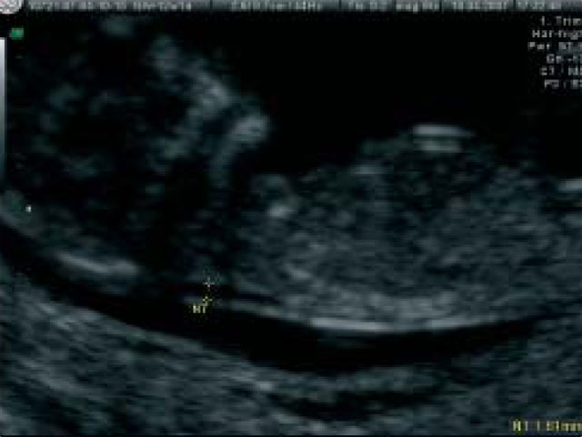 12. teden nosečnosti, preiskava nuhalna svetlina, pri nas tudi na napotnico