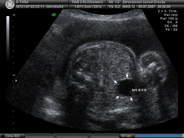 21.-24. teden nosečnosti