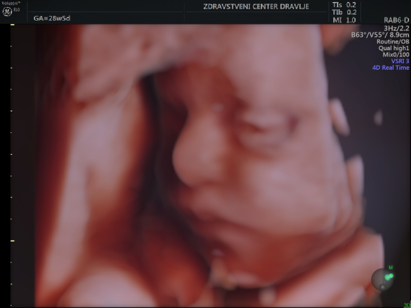 3D-ultrazvok, nosečnost, ZCD