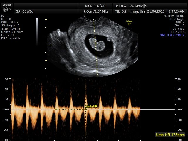 Potrditev nosečnosti, 9. teden nosečnosti, 3D, ZCD